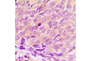 Immunohistochemical analysis of Histone Deacetylase 3 staining in human breast cancer formalin fixed paraffin embedded tissue section. (HDAC3 抗体  (C-Term))