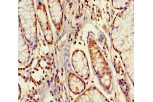 Immunohistochemistry of paraffin-embedded human gastric cancer using ABIN7164529 at dilution of 1:100
