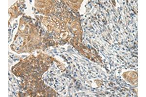 The image on the left is immunohistochemistry of paraffin-embedded Human cervical cancer tissue using ABIN7193020(VIPR2 Antibody) at dilution 1/35, on the right is treated with synthetic peptide. (VIPR2 抗体)