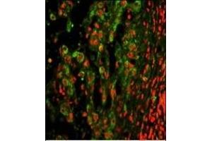 Immunofluorescence analysis of ITGAX Antibody (C-term) with paraffin-embedded human hepatocarcinoma. (CD11c 抗体  (C-Term))