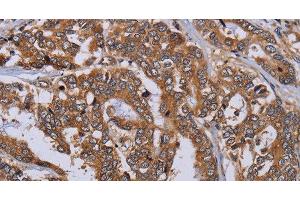 Immunohistochemistry of paraffin-embedded Human liver cancer tissue using MFAP3L Polyclonal Antibody at dilution 1:50 (MFAP3L 抗体)