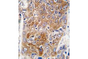 Formalin-fixed and paraffin-embedded human hepatocarcinoma tissue reacted with ALDH1L1 antibody (C-term), which was peroxidase-conjugated to the secondary antibody, followed by DAB staining. (ALDH1L1 抗体  (C-Term))