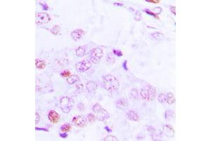 Immunohistochemical analysis of ATF2 (pT69) staining in human lung cancer formalin fixed paraffin embedded tissue section. (ATF2 抗体  (N-Term, pSer69))