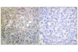 Immunohistochemistry analysis of paraffin-embedded human breast carcinoma tissue using FGFR1 (Ab-766) antiobdy. (FGFR1 抗体  (Tyr766))