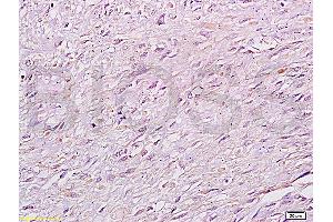 Formalin-fixed and paraffin: human cervical carcinoma labeled with Anti-RB1CC1 Polyclonal Antibody (ABIN872758), Unconjugated at 1:200 followed by conjugation to the secondary antibody and DAB staining (FIP200 抗体  (AA 501-600))