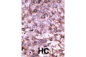 Formalin-fixed and paraffin-embedded human hepatocellular carcinoma tissue reacted with MAGEL2 polyclonal antibody  , which was peroxidase-conjugated to the secondary antibody, followed by DAB staining. (MAGE-Like 2 抗体  (C-Term))