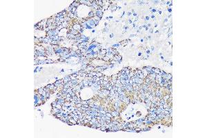 Immunohistochemistry of paraffin-embedded Human colon carcinoma using  Rabbit pAb (ABIN7265368) at dilution of 1:100 (40x lens). (ACAA2 抗体  (AA 1-250))