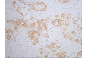 Immunohistochemistry (IHC) staining of Human Breast cancer tissue, diluted at 1:200. (beta Catenin 抗体)