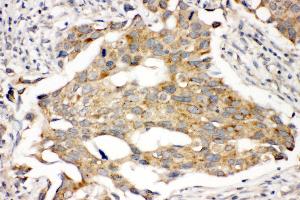 Anti-Prolactin Receptor antibody, IHC(P) IHC(P): Human Mammary Cancer Tissue (Prolactin Receptor 抗体  (C-Term))