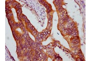 IHC image of ABIN7157699 diluted at 1:600 and staining in paraffin-embedded human colon cancer performed on a Leica BondTM system. (KRIT1 抗体  (AA 471-585))