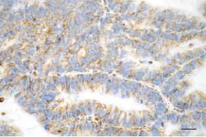 Immunohistochemistry was performed on paraffin-embedded human endometrial carcinoma using vimentin antibody (ABIN7800838), 1:100). (Vimentin 抗体)