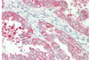 Rabbit Anti-HBEGF antibody Catalog Number: ARP45201 Formalin Fixed Paraffin Embedded Tissue: Human Uterus Primary antibody Concentration: 1:100 Secondary Antibody: Donkey anti-Rabbit-Cy3 Secondary Antibody Concentration: 1:200 Magnification: 20x Exposure Time: 0. (HBEGF 抗体  (N-Term))