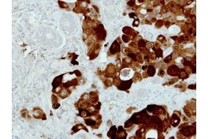 IHC-P Image Immunohistochemical analysis of paraffin-embedded H441 xenograft, using PIG3, antibody at 1:500 dilution. (TP53I3 抗体)