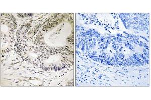Immunohistochemical staining of paraffin-embedded human colon carcinoma tissue reacted with TP53BP1 (phospho S25) polyclonal antibody  at 1:50-1:100 dilution. (TP53BP1 抗体  (pSer25))