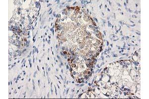 Immunohistochemical staining of paraffin-embedded Adenocarcinoma of Human ovary tissue using anti-MGLL mouse monoclonal antibody. (MGLL 抗体)