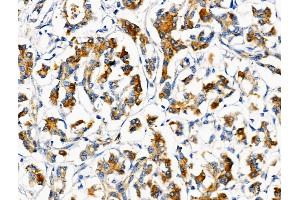 ABIN6259059 and ABIN6274712 at 1/100 staining Human pancreatic cancer and adjacent nomal tissues by IHC-P. (AGPAT5 抗体  (Internal Region))