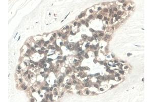 DAB staining on IHC-P; Samples: Human Pancreatic cancer Tissue) (C5A 抗体  (AA 678-751))