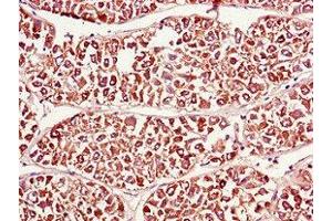 Immunohistochemistry of paraffin-embedded human liver cancer using ABIN7165275 at dilution of 1:100 (PDIA4 抗体  (AA 101-400))