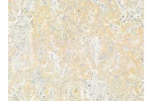 ABIN6264204 and ABIN6279655 at 1/100 staining human lung adenocarcinoma by IHC-P. (PIGC 抗体  (Internal Region))