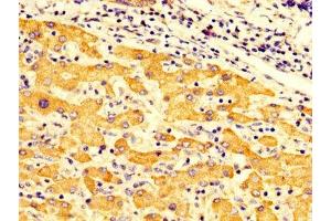 IHC image of ABIN7149956 diluted at 1:300 and staining in paraffin-embedded human liver cancer performed on a Leica BondTM system. (FMO3 抗体  (AA 111-219))