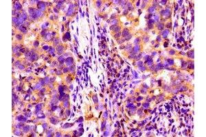 Immunohistochemistry of paraffin-embedded human pancreatic cancer using ABIN7148403 at dilution of 1:100 (Complement Factor I 抗体  (AA 239-316))