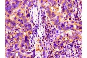 Immunohistochemistry of paraffin-embedded human pancreatic cancer using ABIN7148403 at dilution of 1:100