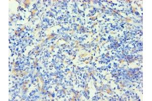 Immunohistochemistry of paraffin-embedded human cervical cancer using ABIN7157384 at dilution of 1:100