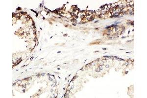 IHC-P: Kallikrein-11 antibody testing of human prostatic cancer tissue (Kallikrein 11 抗体  (C-Term))