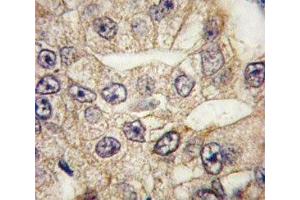 IHC analysis of FFPE human lung carcinoma tissue stained with CD14 antibody (CD14 抗体  (AA 54-83))