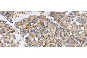 Immunohistochemistry of paraffin-embedded Human liver cancer tissue using MED31 Polyclonal Antibody at dilution of 1:100(x200) (MED31 抗体)
