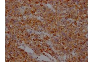 IHC image of ABIN7127835 diluted at 1:100 and staining in paraffin-embedded human glioma cancer performed on a Leica BondTM system. (Recombinant MAPT 抗体)