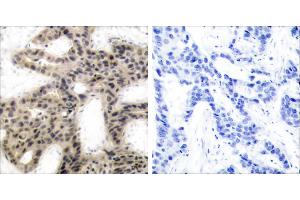 P-Peptide - +Immunohistochemical analysis of paraffin-embedded human breast carcinoma tissue using 4E-BP1 (phospho-Thr45) antibody. (eIF4EBP1 抗体  (pThr45))