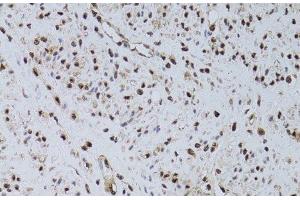 Immunohistochemistry of paraffin-embedded Human uterine cancer using HUS1 Polyclonal Antibody at dilution of 1:100 (40x lens). (HUS1 抗体)