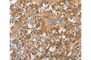 Immunohistochemistry of Human cervical cancer using CUL7 Polyclonal Antibody at dilution of 1:50 (Cullin 7 抗体)