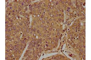 IHC image of ABIN7152998 diluted at 1:100 and staining in paraffin-embedded human liver cancer performed on a Leica BondTM system. (FLCN 抗体  (AA 291-579))