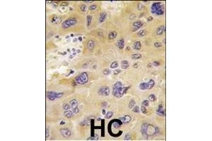 Formalin-fixed and paraffin-embedded human hepatocarcinoma tissue reacted with PFKFB1 antibody (N-term), which was peroxidase-conjugated to the secondary antibody, followed by DAB staining. (PFKFB1 抗体  (N-Term))