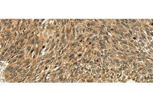 Immunohistochemistry of paraffin-embedded Human lung cancer tissue using PSMD10 Polyclonal Antibody at dilution 1:40 (PSMD10 抗体)