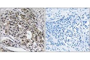 Immunohistochemistry analysis of paraffin-embedded human breast carcinoma tissue, using MRPL13 Antibody. (MRPL13 抗体  (AA 121-170))