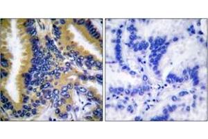 Immunohistochemistry analysis of paraffin-embedded human lung carcinoma tissue, using BIK (Ab-33) Antibody. (BIK 抗体  (AA 18-67))