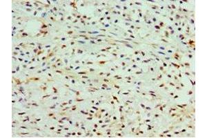 Immunohistochemistry of paraffin-embedded human breast cancer using ABIN7147984 at dilution of 1:100 (COTL1 抗体  (AA 1-142))