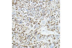 Immunohistochemistry of paraffin-embedded human esophageal cancer using VEGFB Rabbit pAb (ABIN6128909, ABIN6150090, ABIN6150092 and ABIN6216417) at dilution of 1:150 (40x lens). (VEGFB 抗体  (AA 25-207))