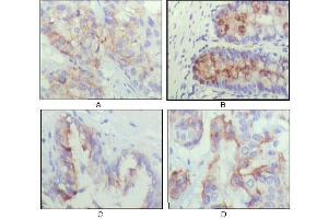 Immunohistochemical analysis of paraffin-embedded human lung cancer (A), recturn(B), prostate (C), colon cancer (D) showing cytoplasmic localization using IGFBP2 mouse mAb with DAB staining. (IGFBP2 抗体  (AA 180-328))