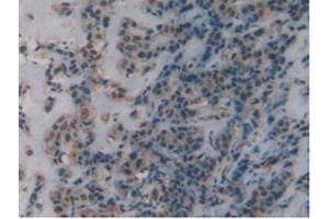 IHC-P analysis of Human Breast Cancer Tissue, with DAB staining. (DBH 抗体  (AA 335-571))
