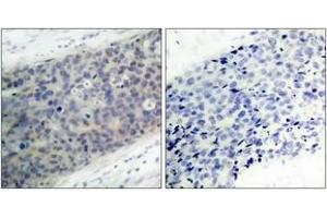 Immunohistochemistry analysis of paraffin-embedded human breast carcinoma, using LIMK2 (Phospho-Thr505) Antibody. (LIMK2 抗体  (pThr505))