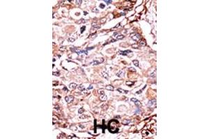 Formalin-fixed and paraffin-embedded human cancer tissue reacted with the primary antibody, which was peroxidase-conjugated to the secondary antibody, followed by AEC staining. (SMAD3 抗体  (pSer213))