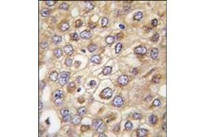 Formalin-fixed and paraffin-embedded human hepatocarcinoma tissue reacted with CLDN2 (Human N-term), which was peroxidase-conjugated to the secondary antibody, followed by DAB staining. (Claudin 2 抗体  (N-Term))