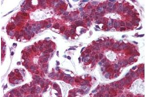 Human Breast (formalin-fixed, paraffin-embedded) stained with PDCD4 antibody ABIN213965 at 5 ug/ml followed by biotinylated goat anti-rabbit IgG secondary antibody ABIN481713, alkaline phosphatase-streptavidin and chromogen. (PDCD4 抗体  (C-Term))