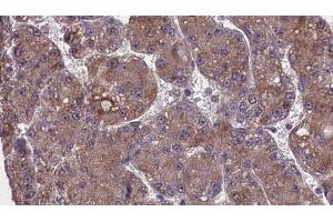 ABIN6274001 at 1/100 staining Human liver cancer tissue by IHC-P. (CD11b 抗体  (Internal Region))