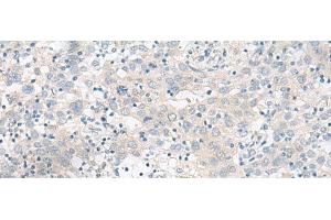 Immunohistochemistry of paraffin-embedded Human cervical cancer tissue using RALGAPA1 Polyclonal Antibody at dilution of 1:55(x200) (GARNL1 抗体)