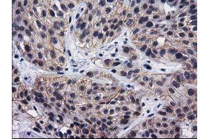 Immunohistochemical staining of paraffin-embedded Carcinoma of Human bladder tissue using anti-DNAJB1 mouse monoclonal antibody. (DNAJB1 抗体)